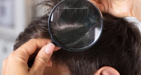 [헬스S] 보기 안 좋은 '비듬'… 머리 자주 감는 게 답일까