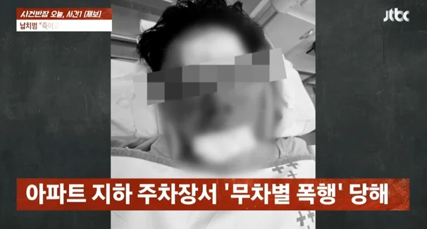 "이대로 죽나 싶었다"… '무차별 폭행' 유튜버 수탉, 안와골절 수술 마쳐