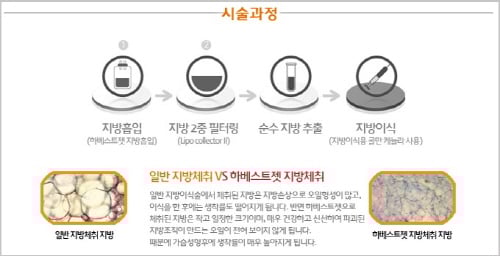 [이근직의 성형칼럼]하베스트젯 가슴성형으로 당당하고 아름다운 S라인 만들기