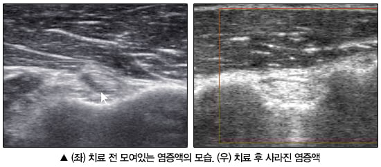 [유상호의 건강칼럼②] 유착성 관절막염 ‘오십견’