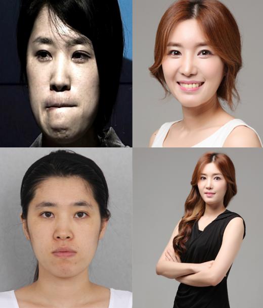 합죽이 입매 걱정 NO! 스마일 양악수술 호평