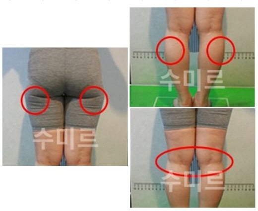 하체비만사례(사진제공=수미르한의원)