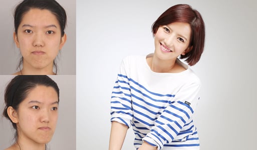 최지혜씨의 수술전후 모습(사진제공=뷰성형외과)