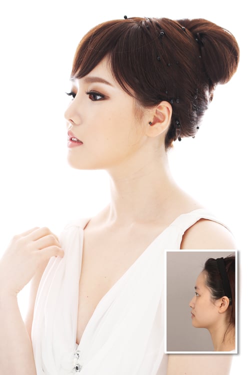 성형전후 사진(제공=뷰성형외과)