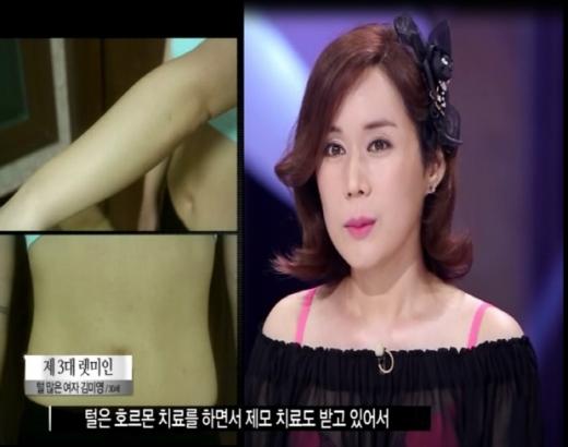 렛미인3 '털 많은 여자' 김미영, 털은 어떻게 없앴나?