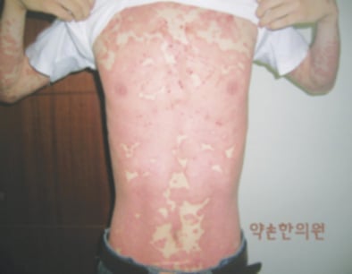 몸과 마음을 괴롭히는 건선, 겉과 속을 같이 다스려야 개선