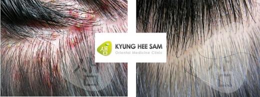 탈모 오기 전에 치료, ‘지루성두피염’ 치료의 해답은