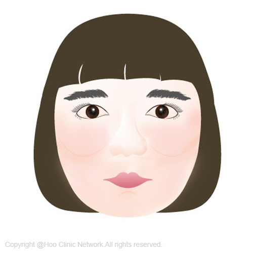 여드름흉터치료, 재생력 좋은 피부가 치료효과 높아
