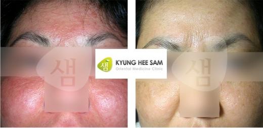 ‘안면지루성피부염’ 재발까지 막는 치료로 마무리해야