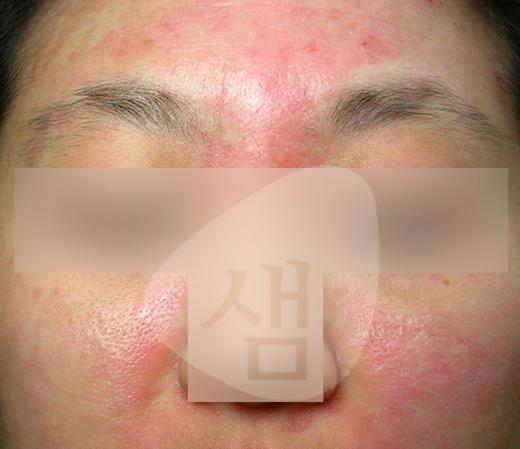 삶의 질까지 저하시키는 지루성피부염…한방치료는 어떻게?