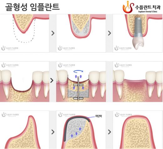 치과 임플란트, 뼈이식이 중요한 이유?