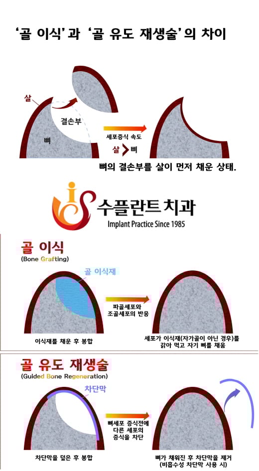 ‘골형성 임플란트’, ‘골 이식술’과 ‘골 유도 재생술’의 차이점