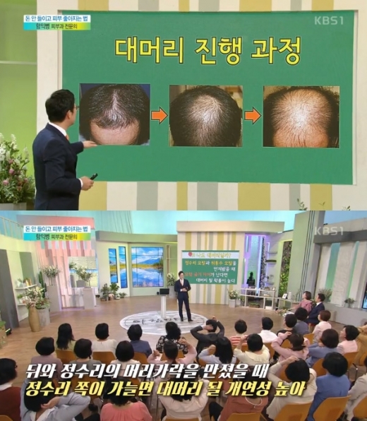 함익병 대머리. /사진=아침마당 방송캡처