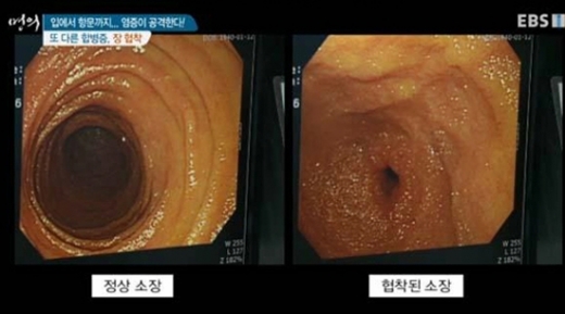 /사진=EBS '명의' 방송화면 캡처