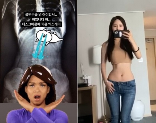 웹툰 '여신강림'의 작가 야옹이(본명 김나영)가 골반 수술 루머에 대해 직접 해명했다. /사진=작가 야옹이 인스타그램 캡처  