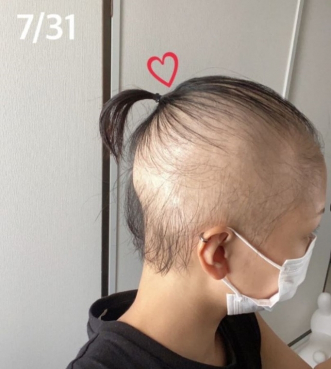 일본에서 한 20대 여성 A씨가 모더나 신종 코로나바이러스 감염증(코로나19) 백신을 접종 후 탈모증에 걸렸다고 주장했다. /사진=A씨 블로그 
