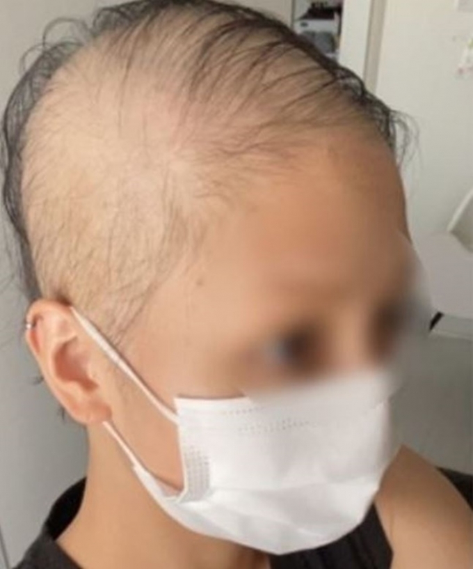 일본에서 모더나 신종 코로나바이러스 감염증(코로나19) 백신 1차 접종 후 탈모 부작용을 주장했던 여성이 2차 접종까지 마쳤다. 사진은 해당 여성이 모더나 백신을 맞은 후 공개한 자신의 모습. /사진=해당 여성 블로그
