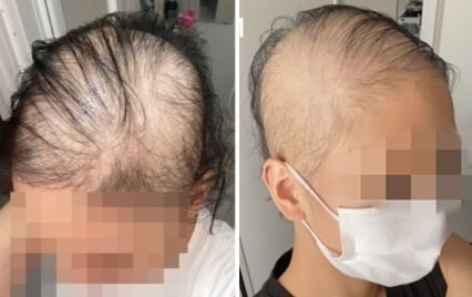 일본의 한 20대 여성이 지난 6월말 모더나 백신 1차 접종을 한 뒤 탈모가 시작됐다며 공개한 사진. (블로그 갈무리) © 뉴스1