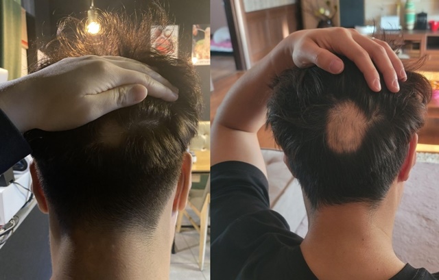 한 남성이 화이자 백신 접종 후 원형 탈모가 생겼다고 주장했다./사진=온라인 커뮤니티 갈무리