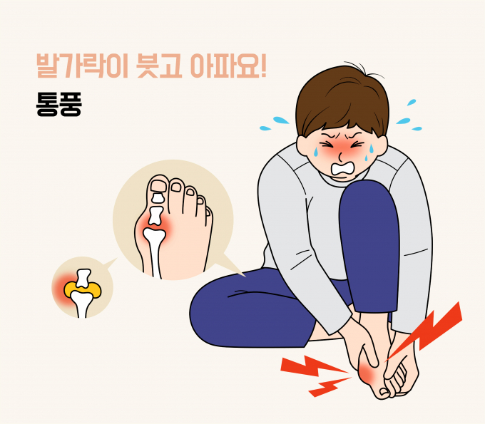 3월16일은 대한류마티스학회가 지정한 통풍의 날이다. 통풍은 최근 9년 동안 환자가 2배 가까이 증가한 만큼 주의가 필요하다./사진=이미지투데이