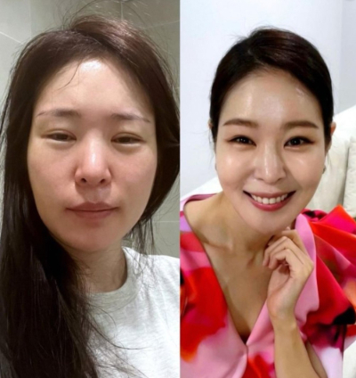 미자, 퉁퉁 부은 얼굴 공개… "완전 딴사람이네"