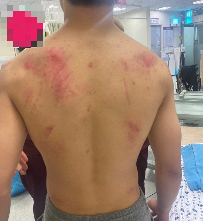 한 중학생이 칼부림 용의자로 오인받아 경찰에 무리하게 진압돼 크게 다친 것으로 알려졌다. /사진=온라인 커뮤니티 보배드림