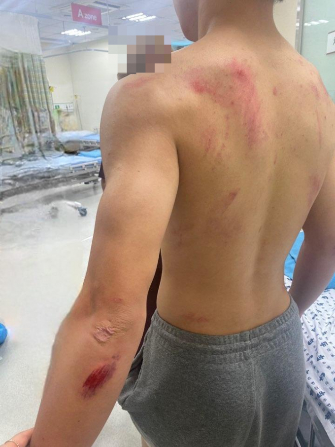 한 중학생이 칼부림 용의자로 오인받아 경찰에 무리하게 진압돼 크게 다친 것으로 알려졌다. /사진=온라인 커뮤니티 보배드림