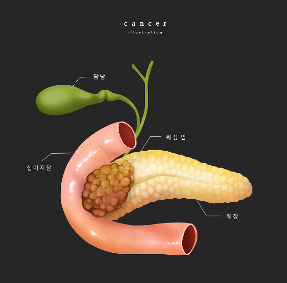고령이어도 췌장암 수술을 포기하지 말아야 한다는 주장이 제기됐다. 사진은 기사의 직접적인 내용과 관련이 없음. /사진=이미지투데이