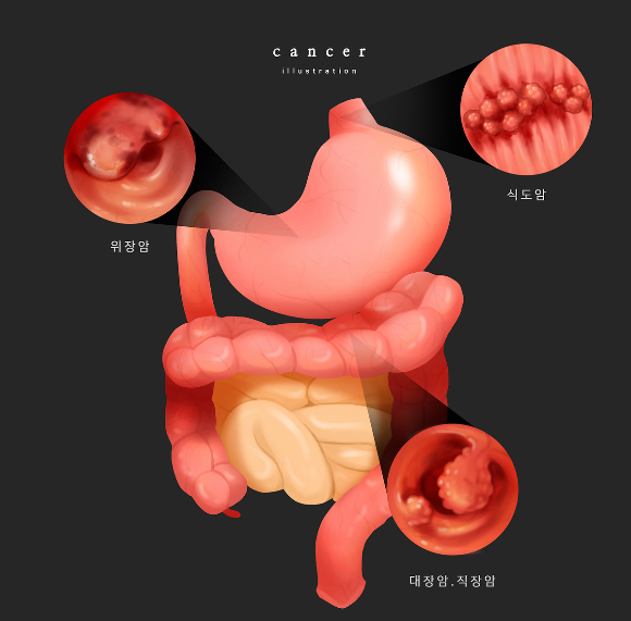 직장암 수술을 하더라도 과거와 달리 항문을 보존할 수 있다. 사진은 기사의 직접적인 내용과 관련이 없음. /사진=이미지투데이