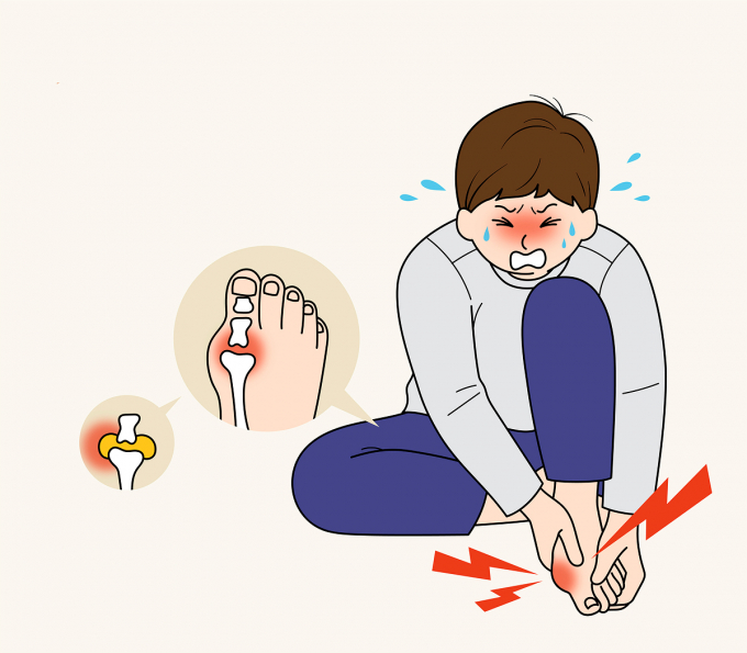 40~50대 남성에게서 발병률이 높았던 통풍이 술, 고지방 음식, 야식 등의 식습관으로 젊은 세대에게서 발병되고 있다. 사진은 기사와 직접적인 관련 없음. /사진=이미지투데이