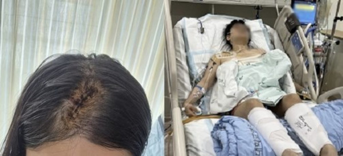 최근 온라인 커뮤니티에는 지난해 부산에서 전 남자친구에게 습격을 받아 크게 다친 여성의 언니가 가해자 출소 후 보복 범죄를 우려하는 내용으로 작성한 글이 올라왔다./사진=온라인 커뮤니티