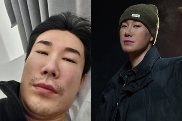 산이가 부비동염에 걸린 근황을 전했다. /사진=산이 인스타그램