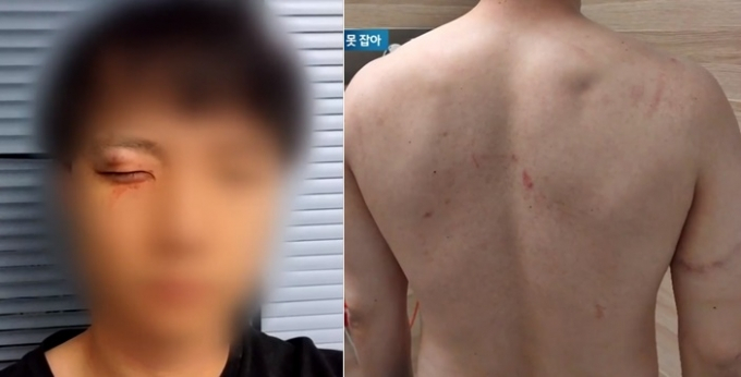 호주로 워킹홀리데이를 떠난 20대 한국 남성이 인종차별로 폭행까지 당했지만 경찰은 3개월 넘게 가해자들을 못 잡고 있다. 사진은 폭행 당한 20대 한국 남성. /사진=머니투데이(JTBC 캡쳐)