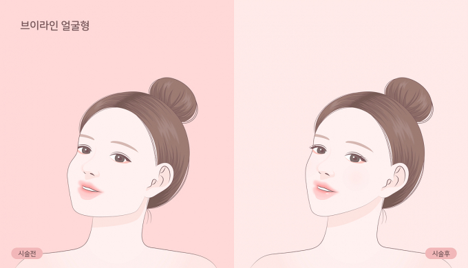 국내 연구진이 보툴리눔 톡신 나보타를 중심으로 사각턱 효과를 확인하면서 치료에도 활발하게 적용될 전망이다. 사진은 기사와 직접적인 관련 없음. /사진=이미지투데이