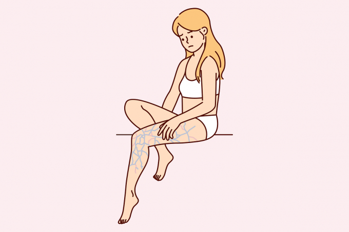 하지정맥류는 더운 날씨로 인해 정맥이 확장하면서 증상이 심해진다. 사진은 기사와 직접적인 관련 없음. /사진=이미지투데이