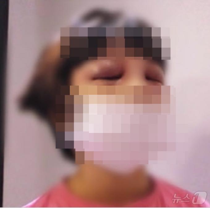 이모 부부로 부터 맞아 눈두덩이가 시커멓게 멍든 딸 사진을 받은 친모는 항의는 커녕 '더 때려 달라'는 듯 복숭아 나뭇가지로 만든 회초리를 보냈다. (MBC 갈무리) ⓒ 뉴스1