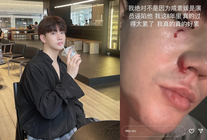 진화가 아내인 배우 함소원에게 폭행을 당했다고 주장한 것은 오해였다며 재차 사과했다. 사진은 진화(왼쪽)가 지난 6일 자신의 인스타그램에 피가 난 얼굴 사진을 공개한 모습. /사진=진화 인스타그램 캡처