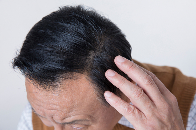 탈모 치료 및 예방법이 주목된다. 사진은 기사 내용과는 무관함. /사진=이미지투데이