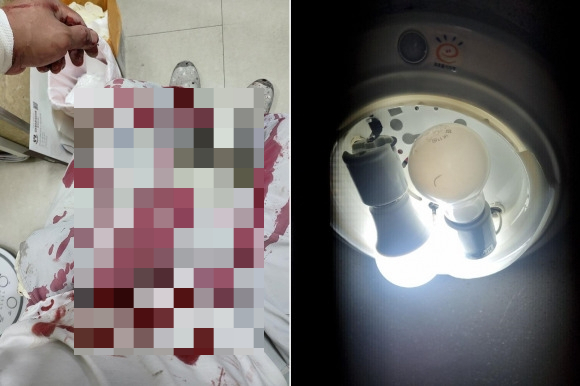경기 김포의 한 아파트에서 천장 조명등 유리가 떨어져 40대 인테리어 작업자가 중상을 입었다는 하소연이 전해졌다. 아파트 천장에서 유리등 커버가 떨어지는 사고를 당한 A씨(왼쪽)의 모습과 당시 천장 조명 사진 /사진=온라인 커뮤니티 캡처