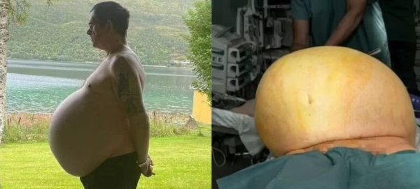 노르웨이의 한 남성이 비만이라고 믿어왔던 뱃살이 거대 악성 종양이었단 소식이 전해졌다. 사진은 사연의 주인공인 토마스 크라우트의 모습. /사진=데일리메일 캡처