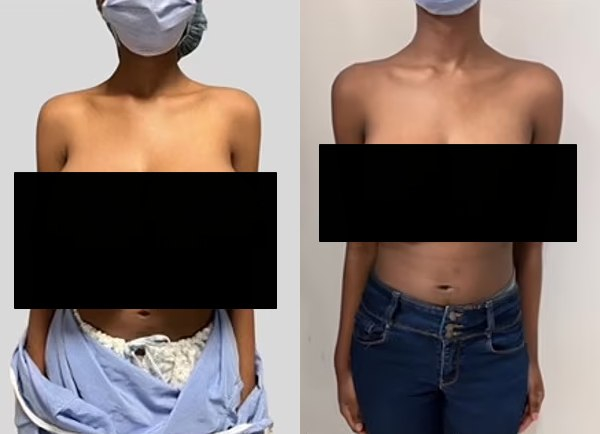 코로나19 백신을 접종한 뒤 가슴 크기가 비대해지는 부작용을 겪은 여성의 사례가 알려졌다. 사진은 백신 주사를 맞은 뒤 6개월 만에 가슴 크기가 트리플G컵이 된 여성과 유방 축소 성형술 이후 더블D컵이 된 여성의 모습. /사진=Plastic and Reconstructive Surgery 캡처