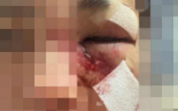 30대 남성이 이별을 통보한 여자친구를 무차별 폭행해 전치 6주에 이르는 부상을 입혔다. 사진은 지난 21일 경북 포항에서 남자친구에게 무차별 폭행을 당해 광대뼈가 함몰된 피해자의 모습. /사진=뉴시스(독자 제공)