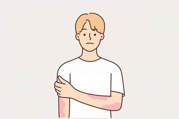 대상포진의 증상과 치료법이 주목된다. 사진은 기사 내용과 무관함. /사진=이미지투데이 