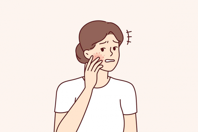 지루성 피부염의 증상과 관리법이 주목된다. 사진은 기사 내용과 무관함. /사진=이미지투데이 