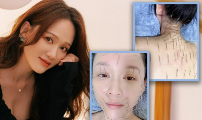 타이완에서 배우로 활동 중인 조 첸 차오엔(46)이 자신의 피부 미용 비결은 침을 맞는 것이라고 밝혔다. 사진은 침을 맞은 조의 모습. /사진=사우스차이나모닝포스트 홈페이지 캡처