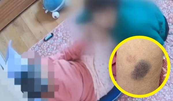 한 요양보호사가 90대 노인을 폭행했다고 외손자가 분통을 터뜨렸다. 사진은 90대 노인을 요양보호사가 학대하는 모습과 노인 몸에 생긴 피멍. /사진=JTBC '사건반장' 캡처