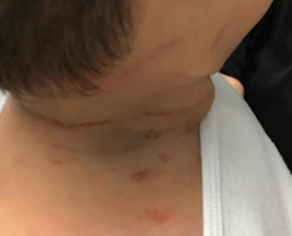 미국에서 생후 15개월 된 남자 아이가 누나의 긴 머리카락에 목이 감겨 일시적으로 의식을 잃는 사고가 발생했다. 사진은 누나 머리카락에 목이 감긴 15개월 남아 모습. /사진=큐어어스 홈페이지 캡처