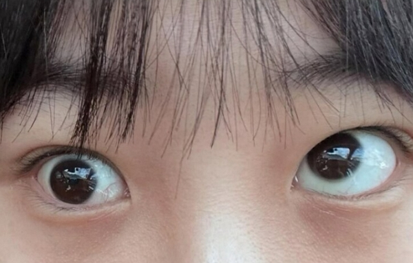 눈 밑 지방 제거 수술을 받은 여성이 한쪽 눈에 사시 증상이 생겼다는 사연이 전해졌다. 사진은 대구 한 성형외과에서 눈 밑 지방 제거 수술을 받은 여성 눈에 사시 증상이 생긴 모습. /사진=JTBC '사건반장' 캡처