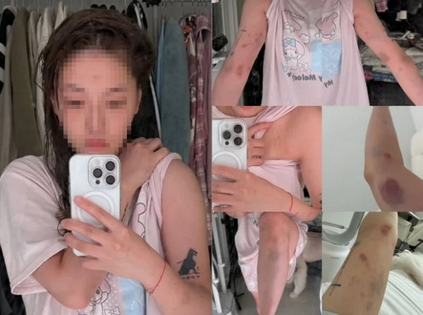 홍대 거리를 걷다 폭행을 당한 대만인 여성 유튜버 사건의 가해자는 한국인 남성이었던 것으로 확인됐다. 사진은 대만 국적 여성이 공개한 폭행 피해 모습. /사진=SNS캡처