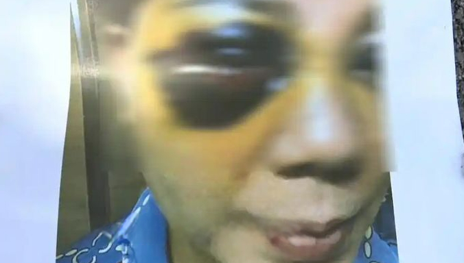 중국에서 성형수술을 받은 한 여성이 부작용으로 변한 얼굴을 공개했다. 사진은 성형 부작용을 공개한 중국 여성의 모습. /사진=중국 매체 환구망 캡처